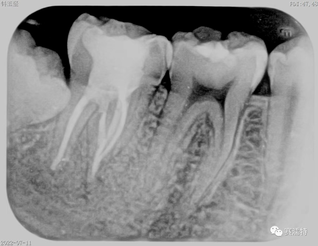 50天根充即刻《右下第一磨牙5根管再治療一例》鄭州市口腔醫院卓越獎