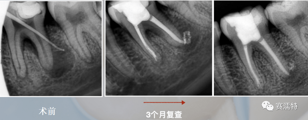 腔 醫 院卓越獎 劉崢術後3個月根充即刻術前《下頜第一磨牙遺漏mm根管