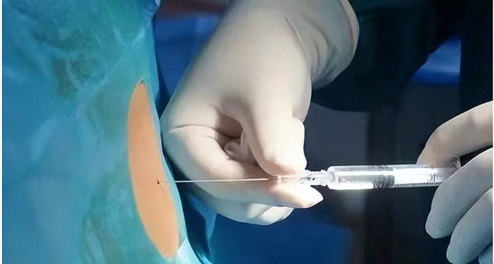 担心腰麻后引起腰疼,头痛,需住院观察等问题,要求进行全身麻醉