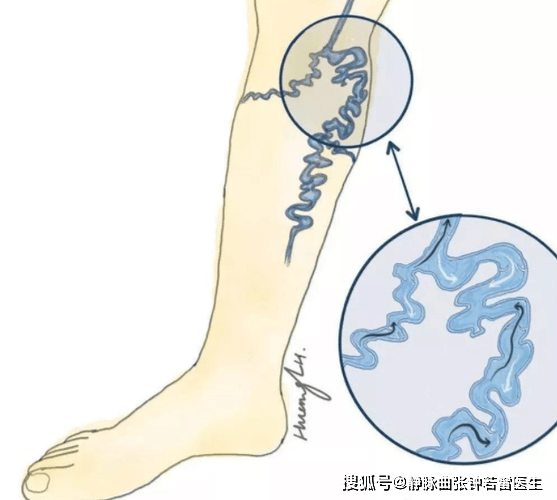 找準病因術前usg下,讓患者站立位,測量大,小隱靜脈與深靜脈匯合處,及