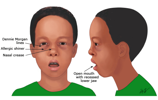 呼吸会对口面部造成影响,主要包括上颌前牙突,开唇露齿,上颌弓缩窄,恒