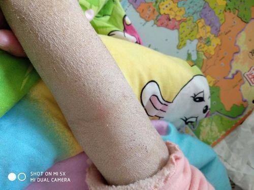 皮肤小百科之秋冬季宝宝皮肤皴裂_孩子_肌肤_部位