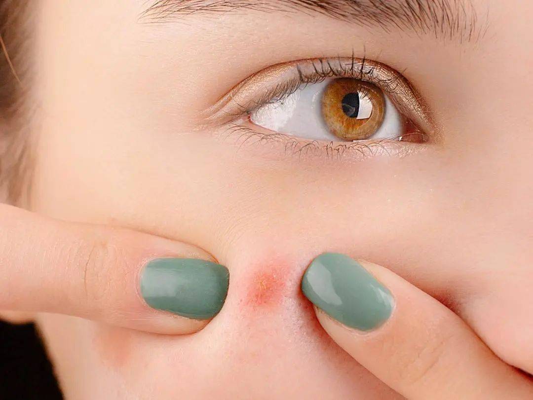 战"痘"秘籍在人的面部有个"危险三角区",三角区的静脉缺乏静脉瓣,在