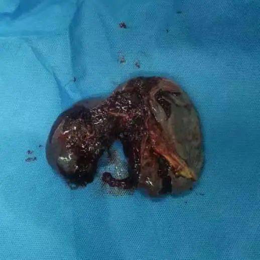 【人民医院为人民】温州又一车祸,脾脏破裂腹腔积血3.