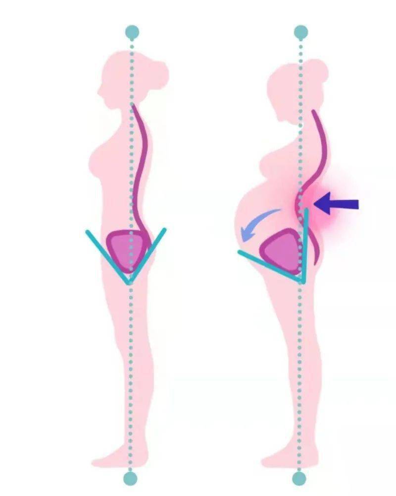 這些都會導致關節受力增加,腰段脊柱前凸,腰椎韌帶鬆弛,骨盆前傾,液體