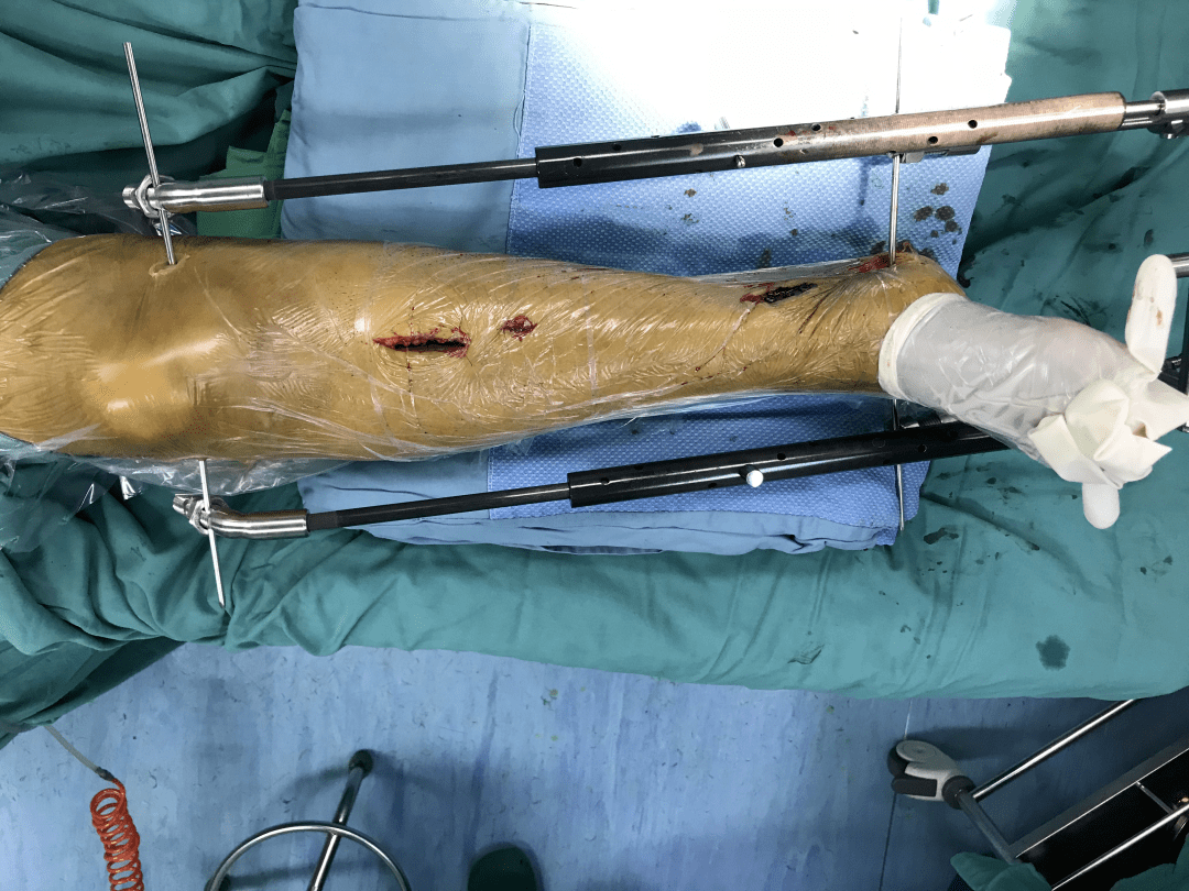 满意在凤城 | 双反牵引 mippo技术助力骨科微创精准治疗_手术_李女士