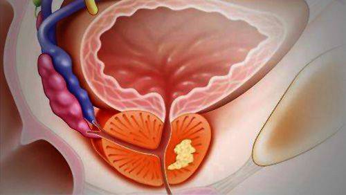 前列腺癌高发人群确实是中老年人,但不排除现在已经有越来越多的年轻