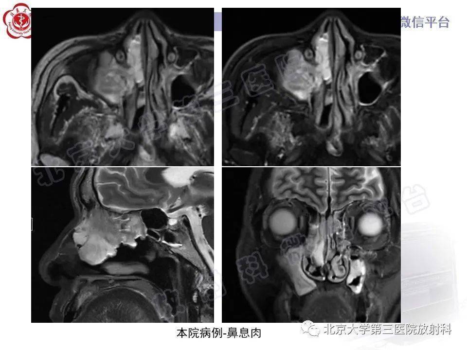 鼻咽纤维血管瘤_全网_影像_解剖图