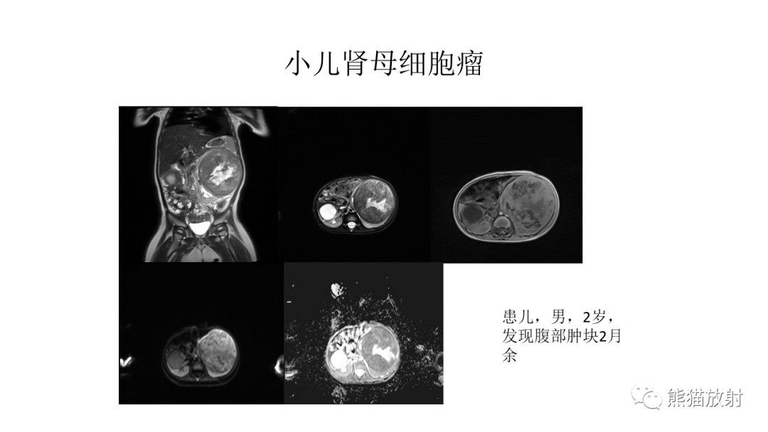 肾母细胞瘤 来自搜狐网