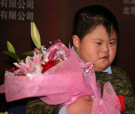 先天性愚型 来自搜狐网