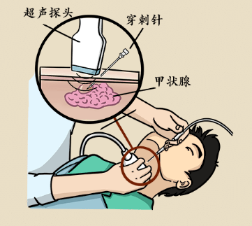 甲状腺穿刺怎么做图片