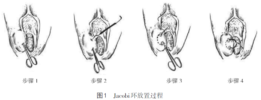 左侧前庭大腺囊肿图片图片