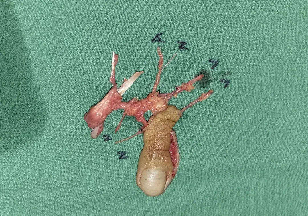 脚趾变手指?临泉首例!成功!