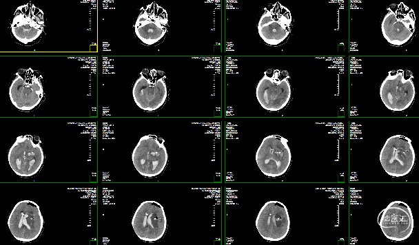 內鏡術後第1日ct左側基底節區腦出血破入腦室:內鏡術前定位ct內鏡術後