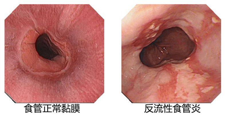 正常人的胃镜食管图片图片