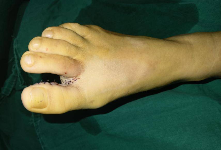 临床上要根据残指的长度,残端情况,以及患者的年龄