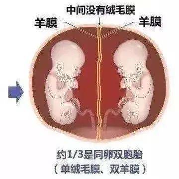 面对这对同卵双胞胎生产难题,“多亏上海专家来了”_绒毛_羊膜_顺产