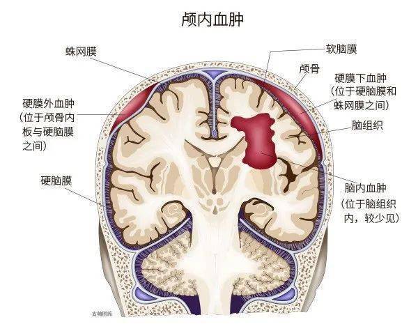 硬脑膜外血肿:脑外伤史 意识障碍(中间清醒期) 瞳孔改变 颅高压症状