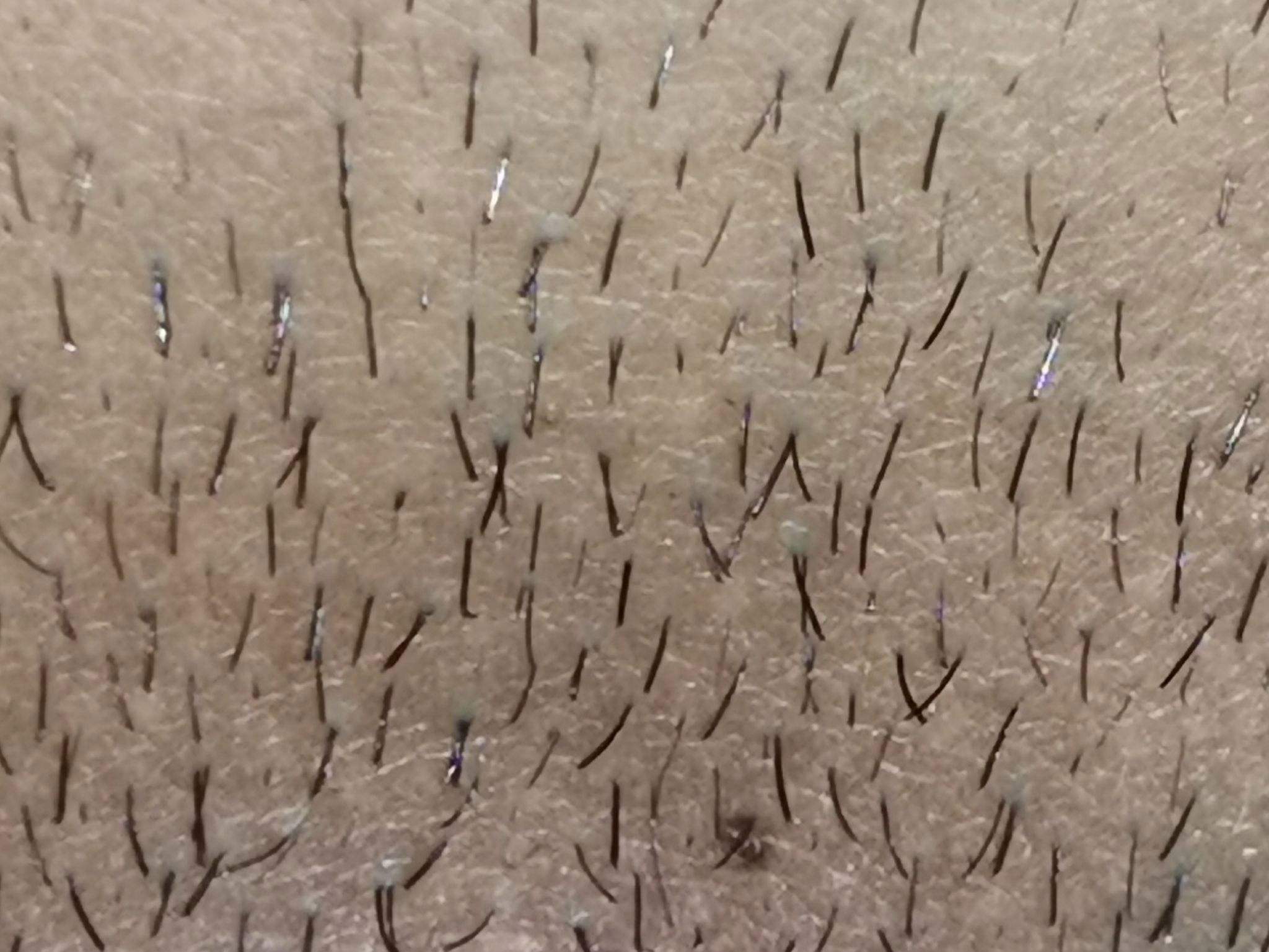 网友:简直防不胜防_阴虱_症状_患者