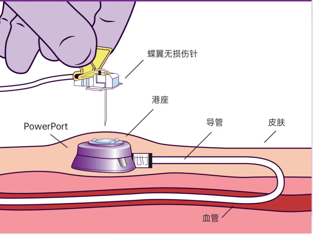 无损伤针,置入静脉的导管,埋藏在皮下与输液针连接的注射座(港体)