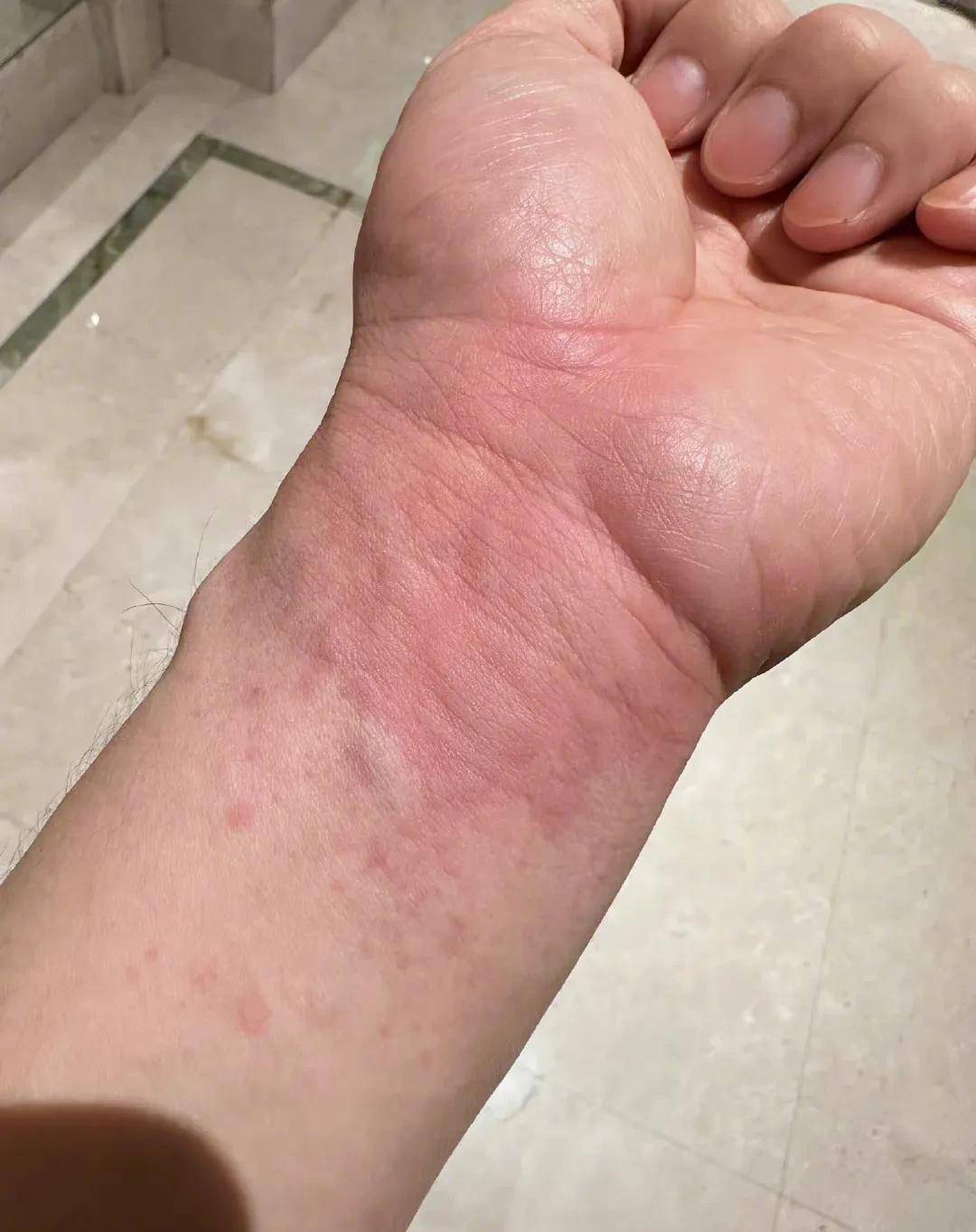 黄晓明在老家突患疾病:肠胃炎和急性荨麻疹!发文讲述悲惨经历