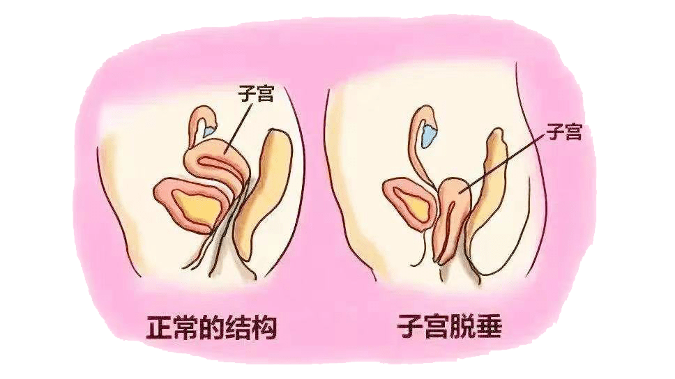 甚至脱出于处女膜缘外,包括阴道前壁脱垂(膀胱膨出),子宫脱垂,阴道后