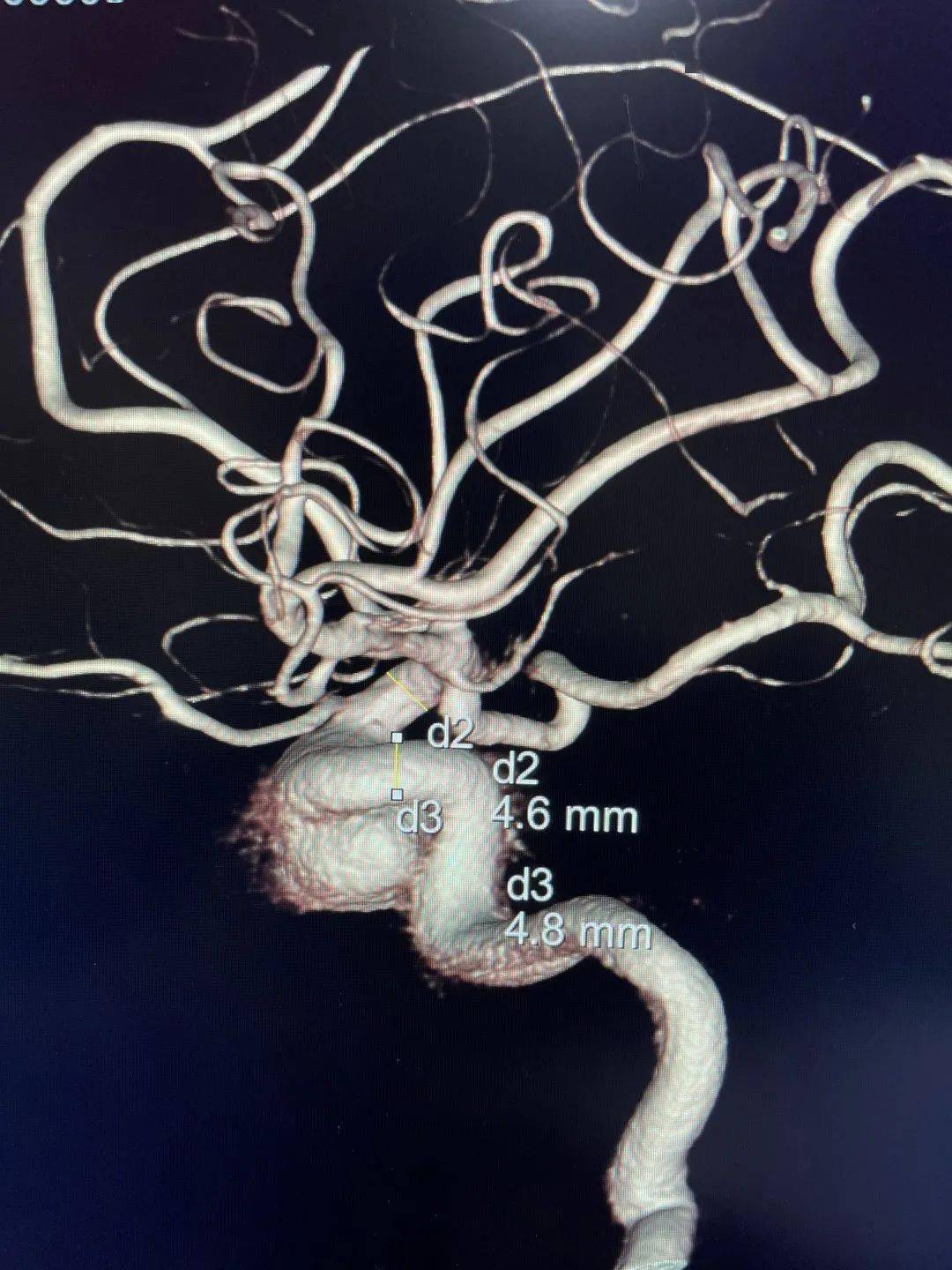 美力管例局丨专访周小兵教授:踔厉奋发,百舸争流;navien颅内支撑导管