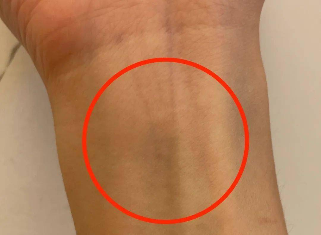 内关处出现"青筋",可能预示着心脏疾病.