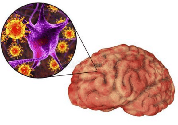病毒性脑炎会引发什么疾病吗?有以下几种并发症_治疗_患者_后遗症