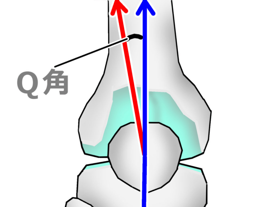 q角及膝外翻如何矫正x型腿x型腿带来的问题q角及膝外翻