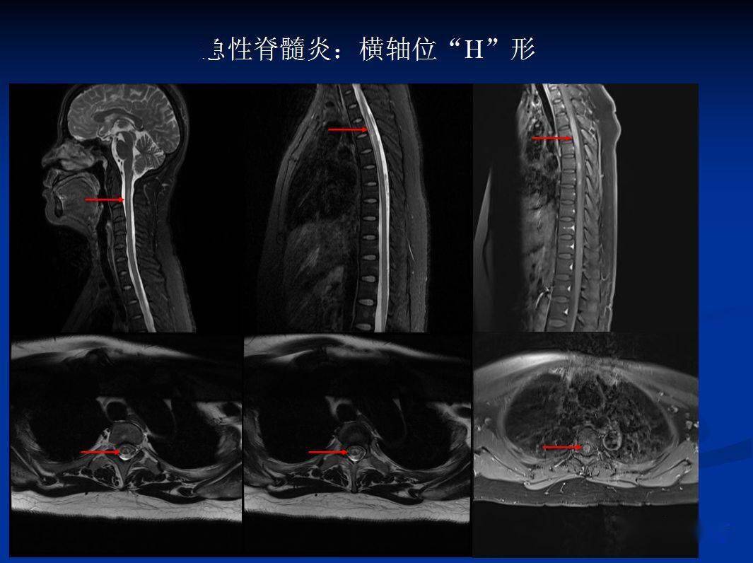 脊髓炎核磁共振图片