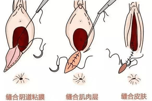 自然分娩侧切图片