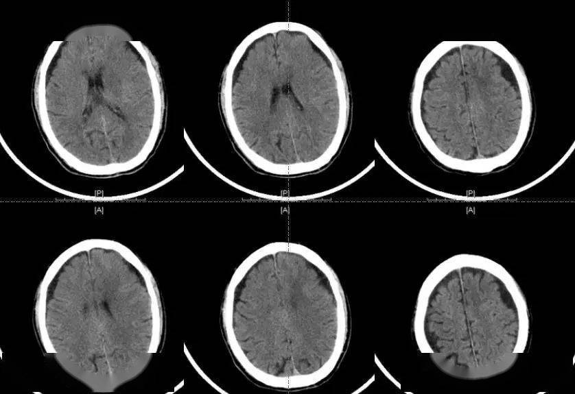 头颅ct:术前影像02考虑患者有心房颤动,脑梗塞可能性大,直接介入治疗