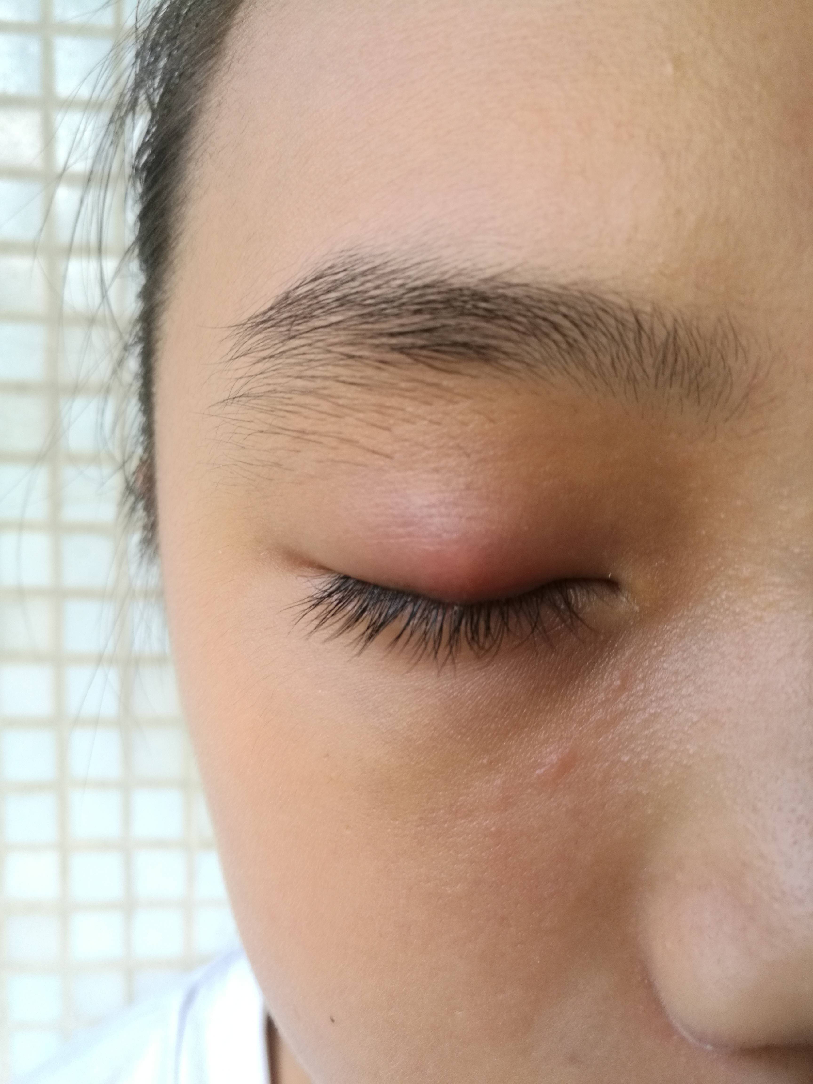 过敏性眼睑炎怎么治疗图片
