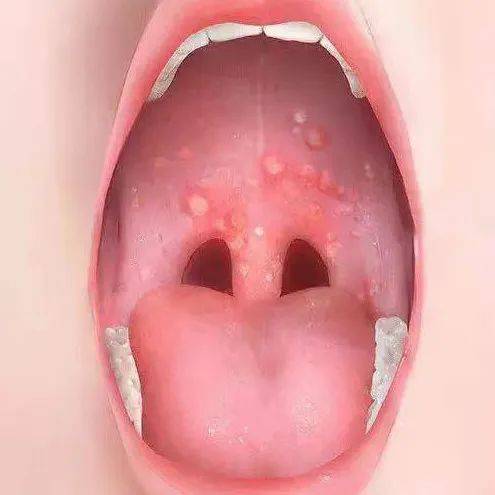 水疱期:2~3天,除高烧外,上颚粘膜出现水疱