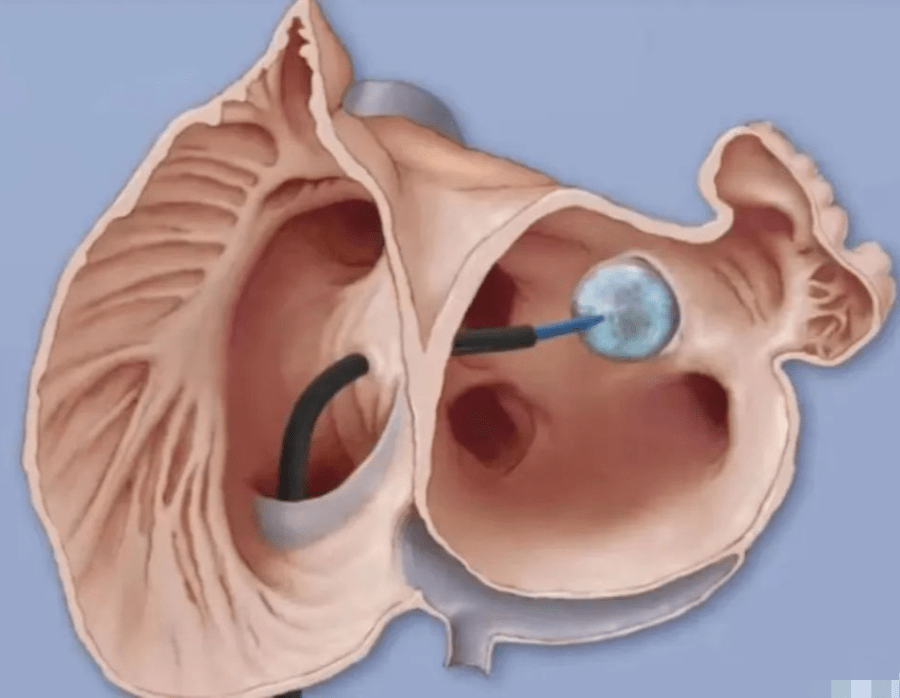 【关注】永安总医院心内科完成首例阵发性房颤冷冻球囊消融术_患者
