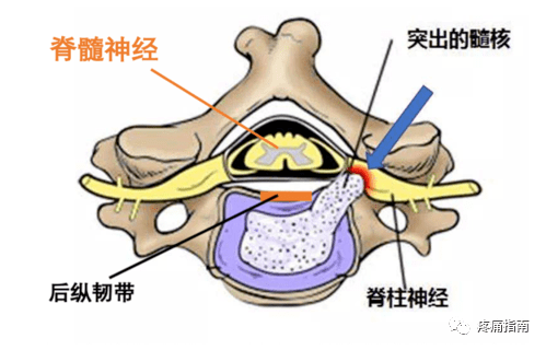 引起手麻的疾病总结_神经_麻木_压迫