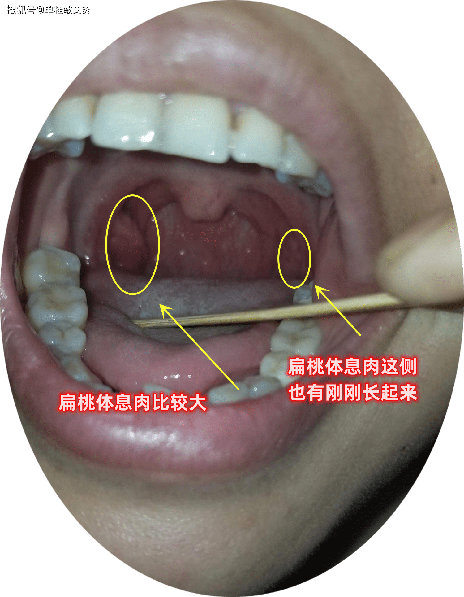 扁桃体上长了个息肉图片