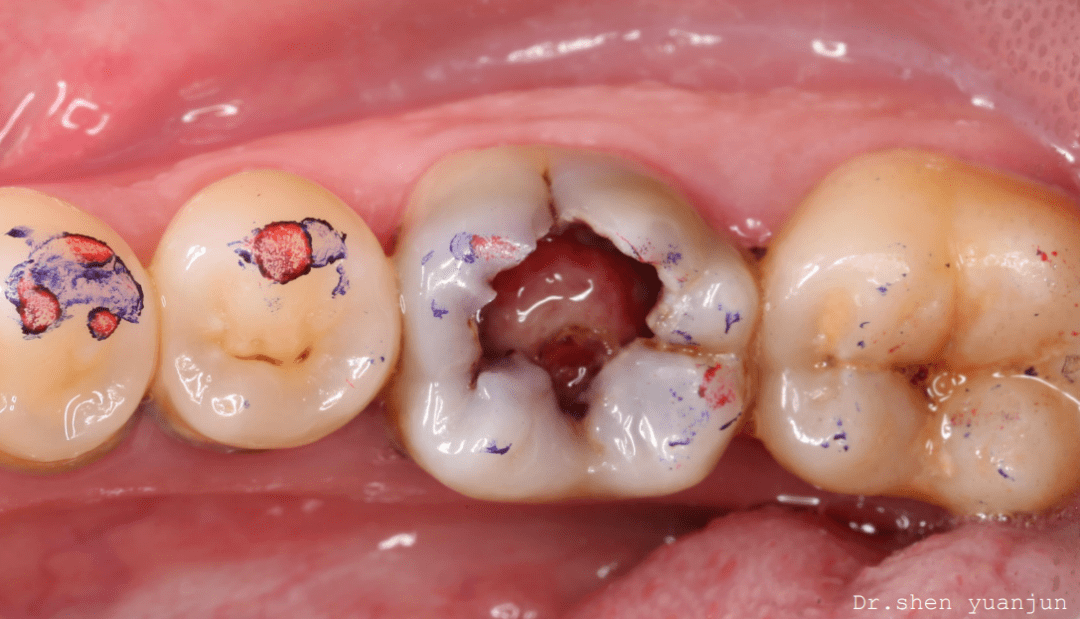 临床检查:3619面大面积龋洞,边缘不规则,内见牙髓息肉及腐质,冷( )