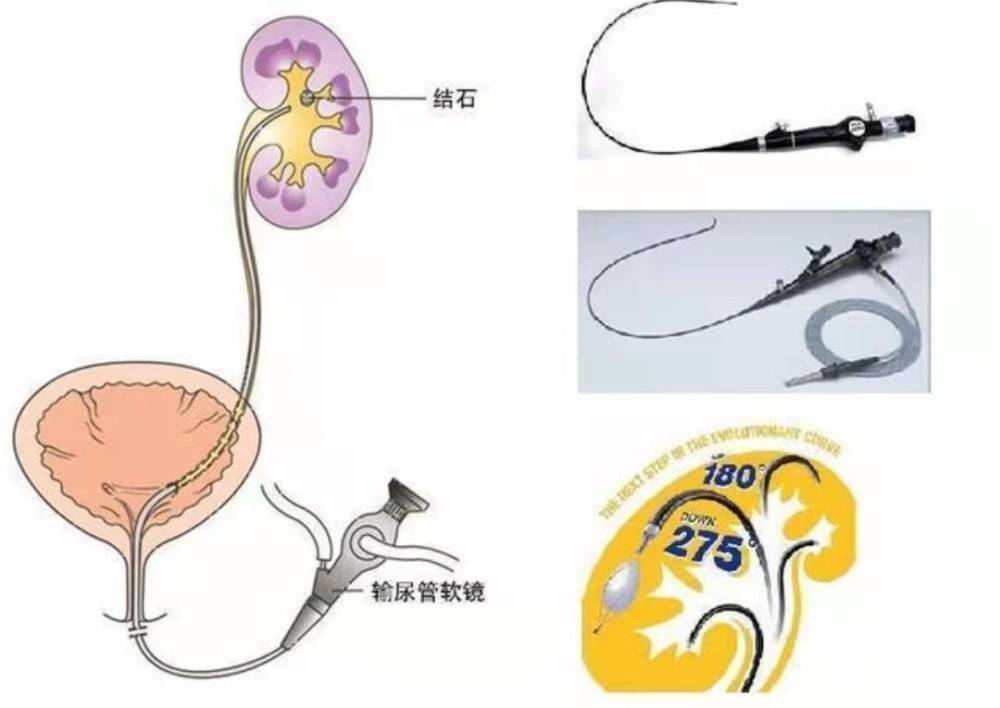 输尿管镜进镜技巧图片图片