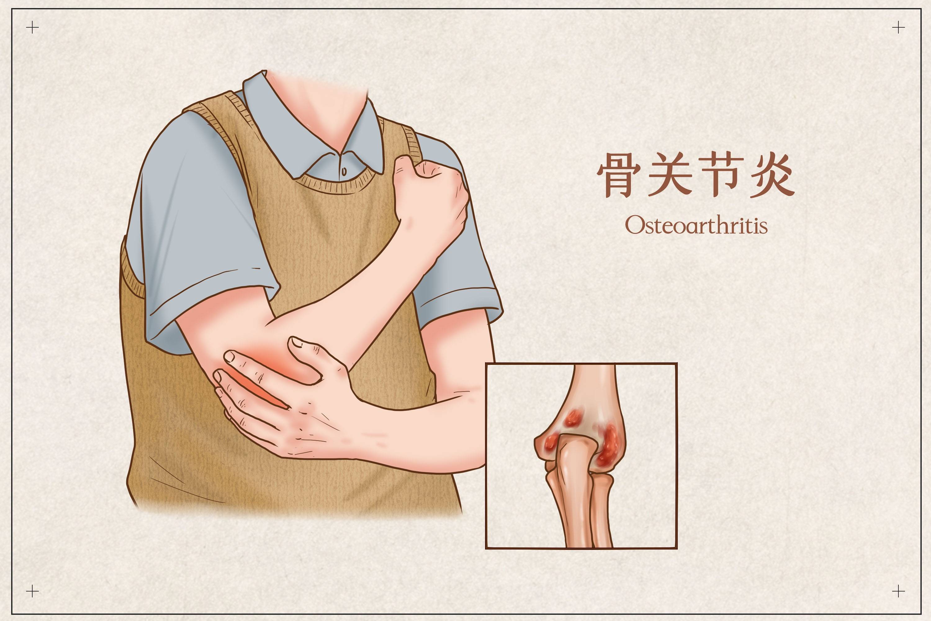 通过中医特色疗法治疗退变性骨关节炎等疾病