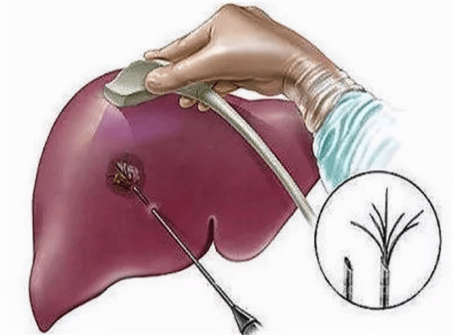 肝脏b超发现这3种异常症状不用怕!_进行_影响_治疗