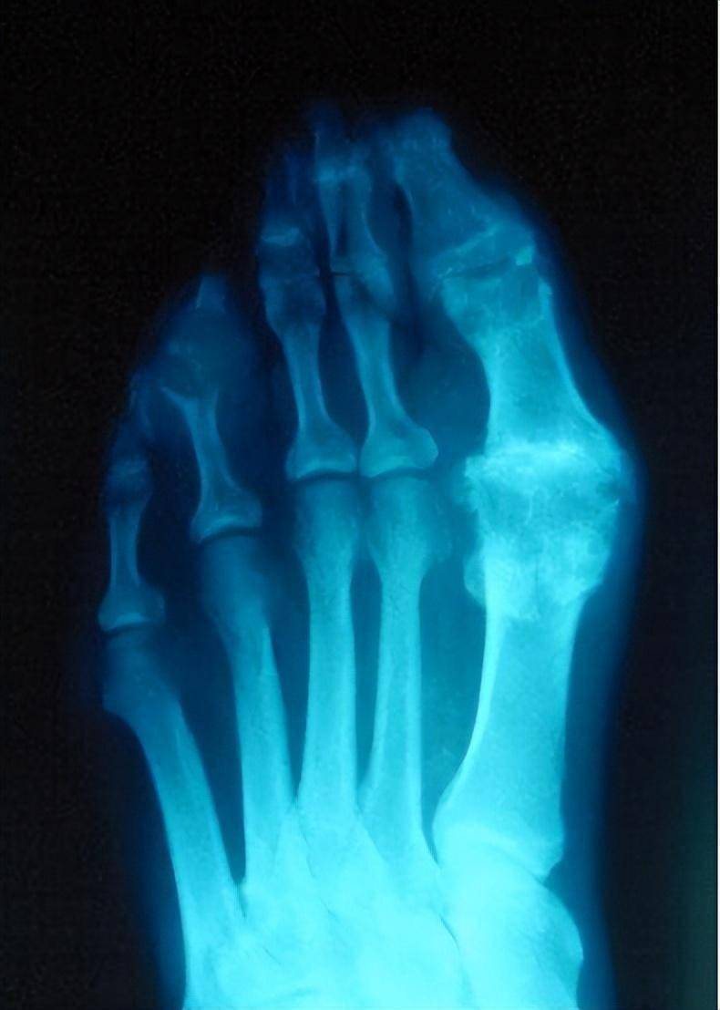 12张图,看清楚痛风的真实面目,最后1张图谨慎观看