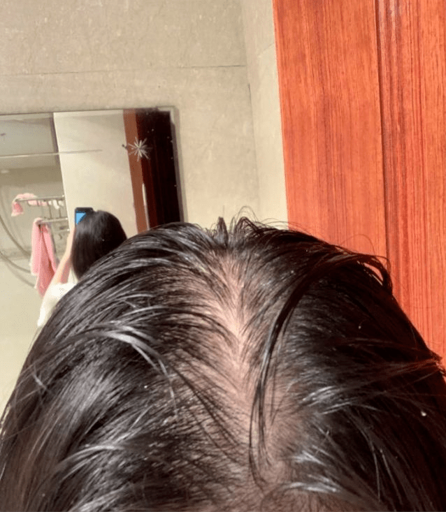 脱发还在乱用偏方?过来人披露生发小妙招,新发一茬接一茬!