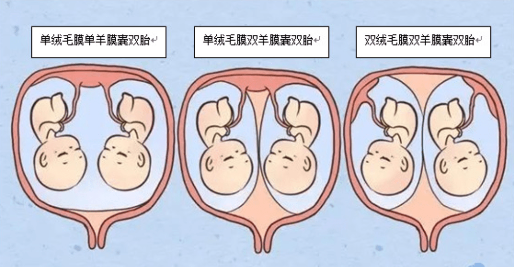 22年前浙江首例连体婴分离手术的存活者现在过得怎么样了(连体婴儿是怎么产生