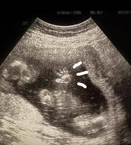 今年10月,欧阳靖在网上晒出自己的b超照,宣布自己怀孕,在接受采访时