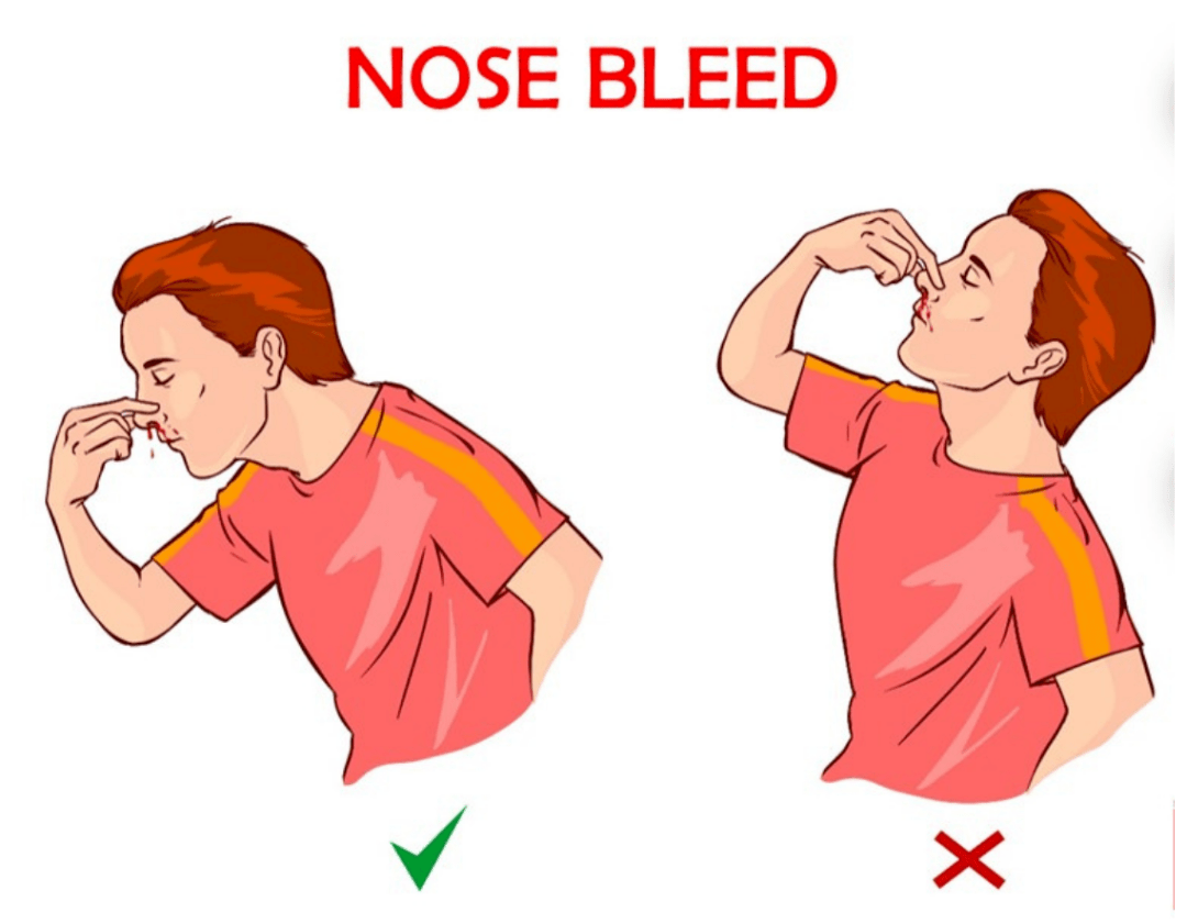 防止窒息);79按压鼻翼而非鼻梁;79中等力度压迫(既能将鼻翼压迫到