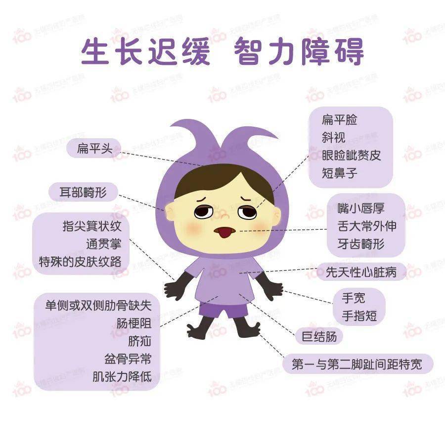 唐氏综合征也就是常说的21三体综合征,是一种常见的染色体疾病,病症