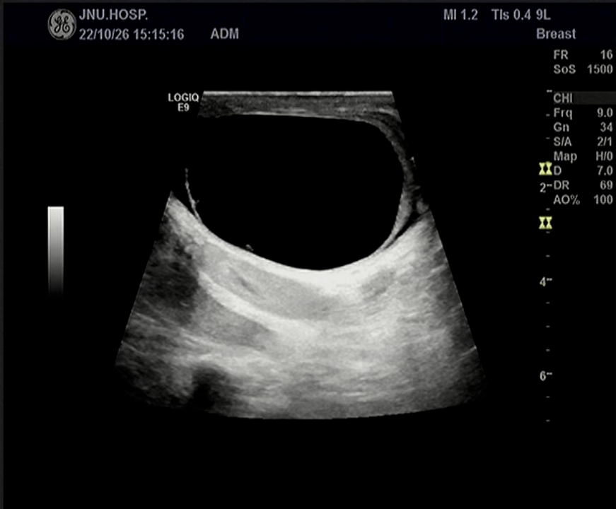 左侧阴囊内未见睾丸及附睾回声,建议进一步检查超声提示双侧阴囊内另