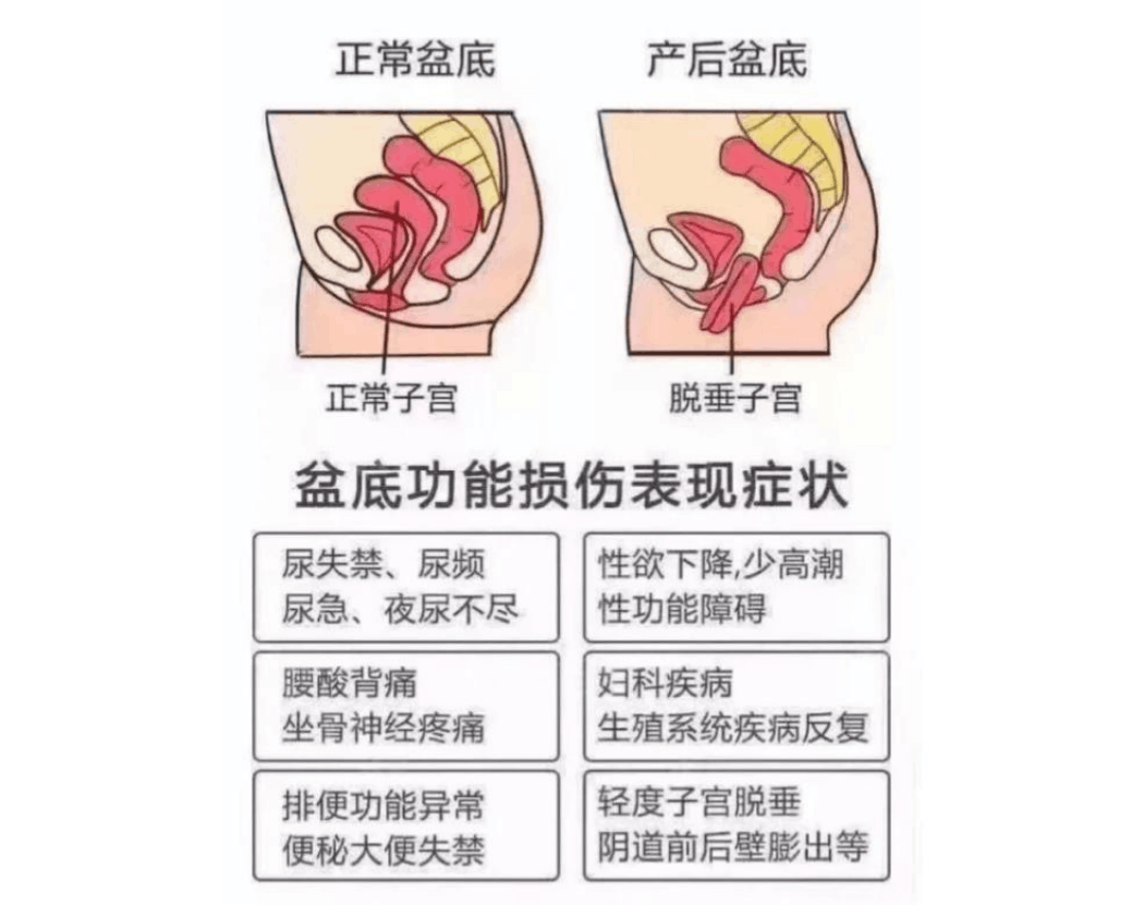 关于产后盆底肌修复,你知道多少?_损伤_运动_锻炼